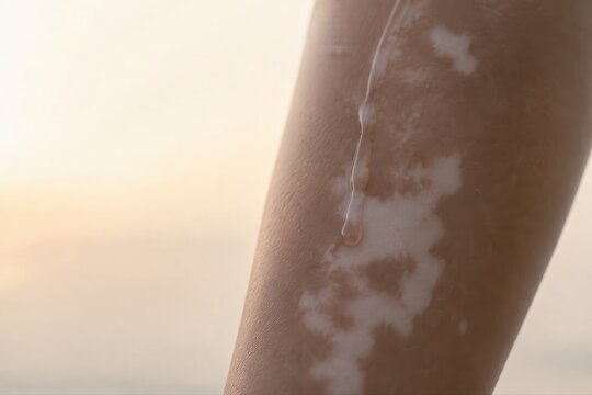 Vitiligo skin closeup with warm sunlight and water droplet