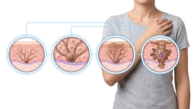 Pulmonary Fibrosis Lung Fibrosis Interstitial Lung Disease Respiratory Health, Medical illustration showing progressive scarring of lung tissue and damaged alveoli
