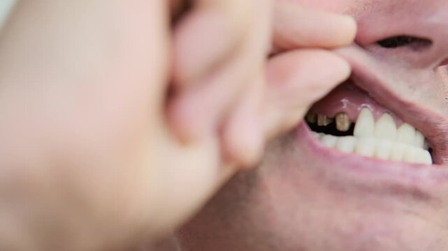 closeup funny senior man showing dental bridge and natural teeth, partial denture visible, mixed teeth, oral health, dental prosthetics, emotional smile, stomatology, before and after open-mouthed