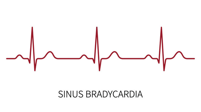 A dark red sinus bradycardia heartbeat line graph showing slow electrical rhythm patterns on a clean minimalist white background surface