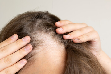 Fototapeta premium Young woman concerned about hair loss holding hairbrush