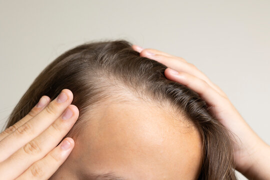 Young woman concerned about hair loss holding hairbrush