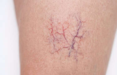 Fototapeta premium Spider Veins and Telangiectasia on Human Leg, Vascular Skin Condition Close Up