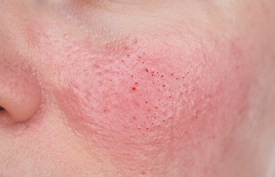 Severe facial redness rosacea and pinpoint petechiae bleeding on cheek skin close up