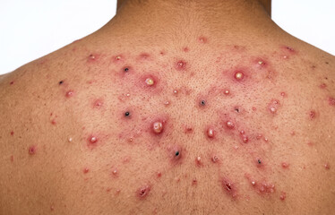 Fototapeta premium Severe Cystic Acne and Pustules on Male Back, Dermatological Skin Infection Close Up