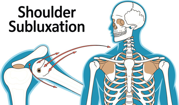Shoulder Subluxation Anatomy Diagram Showing Partial Glenohumeral Joint Dislocation with Human Skeleton, Shoulder Bones, and Medical Orthopedic Illustration for Education