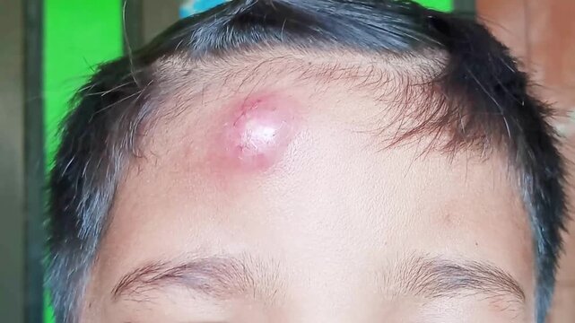 Medically, the cause of a boil is a bacterial infection of a hair follicle, most commonly triggered by *Staphylococcus aureus* bacteria. These bacteria normally live on the surface of human skin.