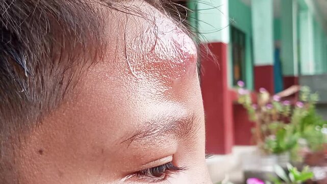 An infection of the hair follicle that causes a painful, pus-filled lump&mdash;commonly known as a boil&mdash;is usually caused by *Staphylococcus aureus* bacteria. Consult a doctor to avoid infection.