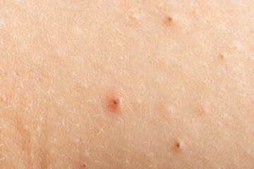 Fototapeta premium Close up epidermis with inflamed follicles and acne. Acne on skin closeup photo. Skin rash texture with acne. Irritated acne skin.