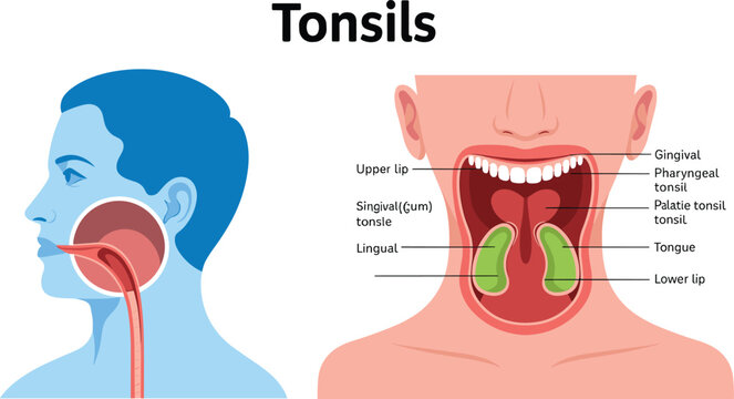 Human tonsils anatomy medical vector illustration showing palatine tonsils, pharynx, tongue and oral cavity structures for healthcare education and clinical reference