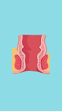 Animation of hemorrhoids and rectal inflammation medical illustration
