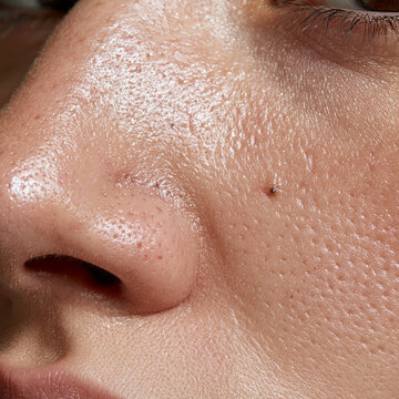 Macro close up of oily nose skin with enlarged pores and blackheads
