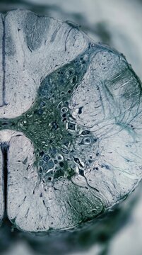 Atrophy SMA pathology: spinal cord, motor neuron, muscular degeneration, ventral horn, gray matter, histological slice, neurological disease, cellular damage, tissue specimen.