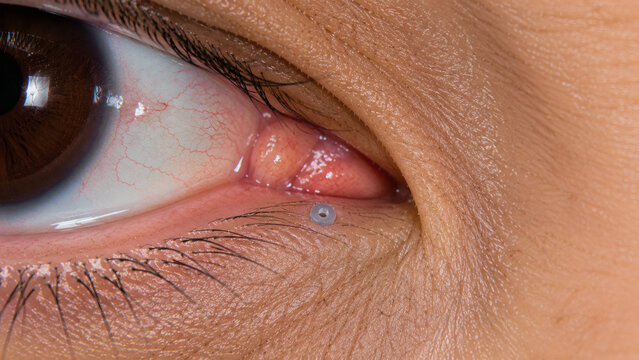 Punctal Plug for Dry Eye Treatment Close Up of Lacrimal Punctum Occlusion Device