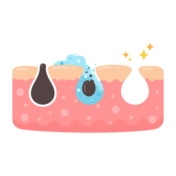 Visual guide illustrating blackhead removal, deep pore cleansing, and skin purification process