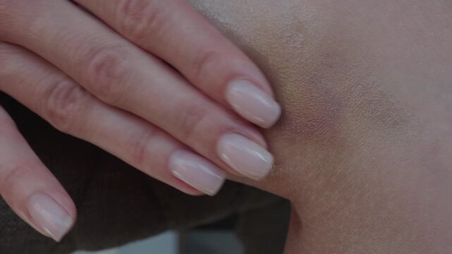 Close-up of female fingers gently spreading transparent medical ointment or gel over a dark purple hematoma on a thigh. Detailed view of skin injury treatment under natural light.