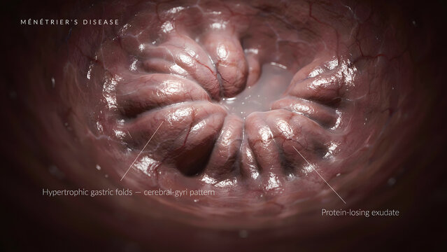 Medical illustration of hypertrophic gastric folds in a human stomach