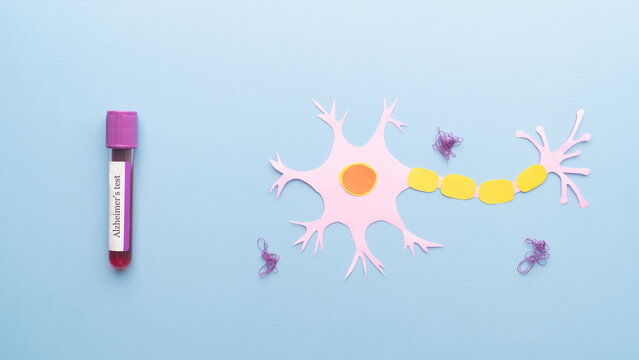 Nerve cells in neurodegenerative disease with amyloid plaques on light blue background. Blood sample tube with Alzheimer test label that can help detect early signs of Alzheimer&rsquo;s disease.