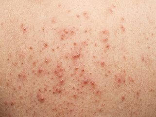 Fototapeta premium Close-up of human skin with uneven, bumpy texture and reddish spots