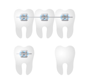 Illustrative depiction of teeth with metal braces and a single tooth without any dental hardware. Dental braces on teeth for orthodontic treatment and alignment correction
