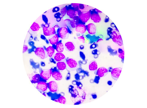 Blood cancer cells acute myeloid leukemia (AML) analyzed by light microscope..
