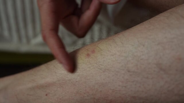 Close-up cropped shot of unrecognizable man pointing at insect bite on leg. Skin showing redness, irritation, small bump from mosquito, bug. Medical, health, dermatology concept, slow motion.