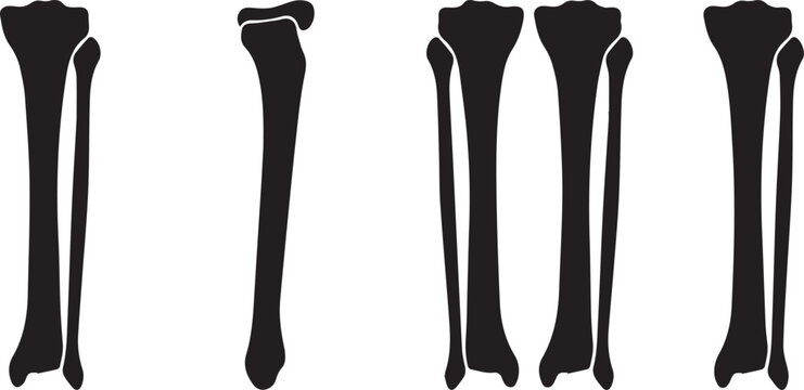 Set of five human leg bones with surgical implants. Medical femur prosthetics for orthopedic joint replacement and trauma recovery.