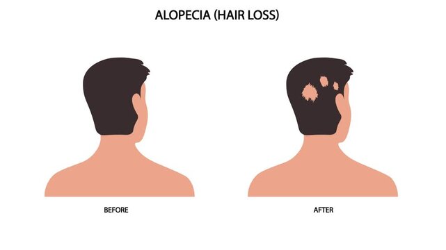 Medical vector animation illustrating alopecia with visible patchy hair loss on the scalp, highlighting hair follicle dysfunction and related conditions such as baldness, alopecia areata, telogen 