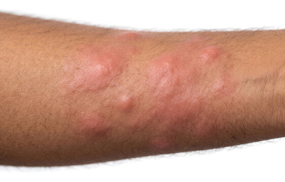 Close up of severe hives urticaria and allergic reaction red welts on human arm.