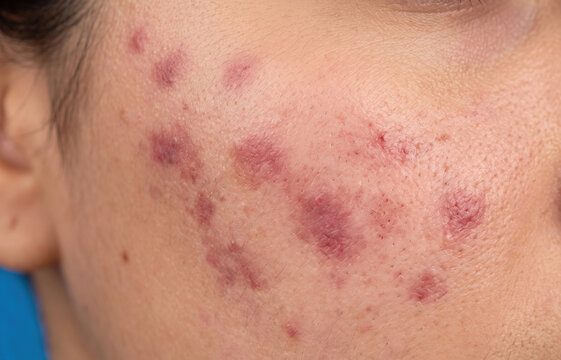 Close up of post inflammatory erythema red acne scars and marks on human face cheek.