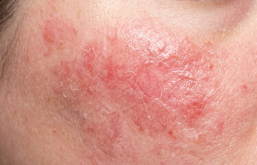 Fototapeta premium Extreme macro close up of severe contact dermatitis damaged skin barrier and red weeping rash on face.