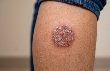 Fototapeta premium Nummular eczema discoid dermatitis displaying a severe dry scaly cracked circular plaque on leg