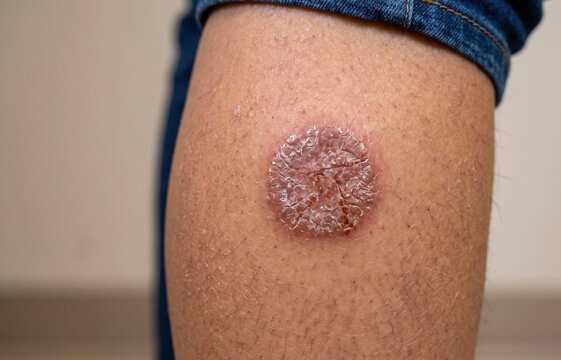 Nummular eczema discoid dermatitis displaying a severe dry scaly cracked circular plaque on leg