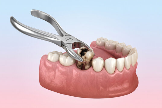 Human Lower Jaw Model Demonstrating Tooth Removal Procedure with Dental Forceps for Training and Illustration