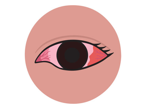 Eye Injuries Clip Art Illustration