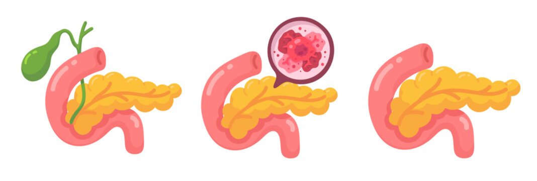 Pancreatic Anatomy and Cancer A Comprehensive Medical Illustration for Healthcare Education.