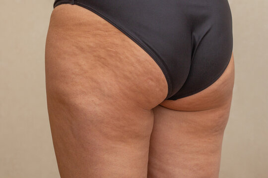 The image shows the buttocks and thighs with pronounced cellulite and a black swimsuit-style garment
