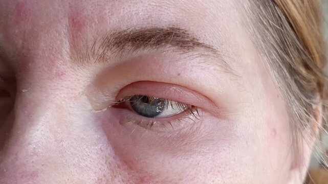 Human eye with visible swelling around eyelid, facial edema, eye irritation and health problem concept.