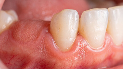 Fototapeta premium Close-up view of healthy gums and teeth showcasing pink and white hues, highlighting dental anatomy