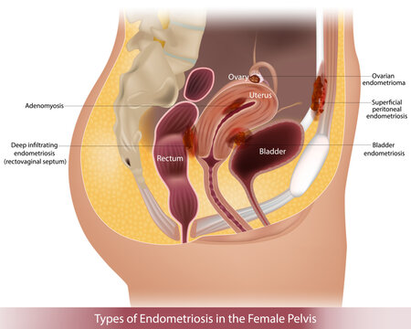 Medical illustration of different types of endometriosis in the female pelvis, including adenomyosis, ovarian endometrioma, superficial peritoneal endometriosis, deep infiltrating endometriosis of the