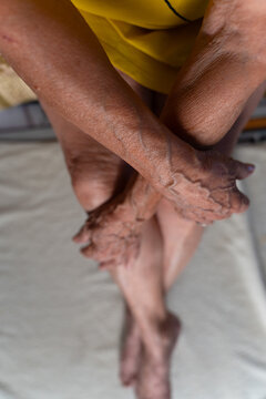 Senior woman with aging skin on hands and legs