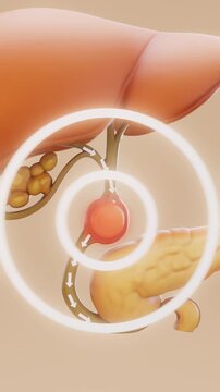 Vertical Medical Animation of Biliary Obstruction Caused by Gallstones in Human Anatomy 4K