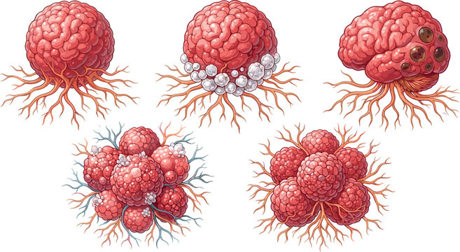 Human brain anatomy and neurological medical conditions vector diagram set with cancer tumor growth cells and disease pathology illustrations