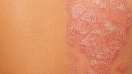 Fototapeta premium Skin with psoriasis showing patches and healthy skin on background 