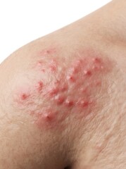 Fototapeta premium Close up of human skin with red rash and inflammation symptoms