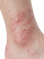 Fototapeta premium Medical image showing red skin rash and swelling on a human foot