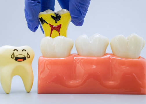 Educational Dental Model Showing Multiple Cavities and Tooth Decay with Sad Crying Tooth Character