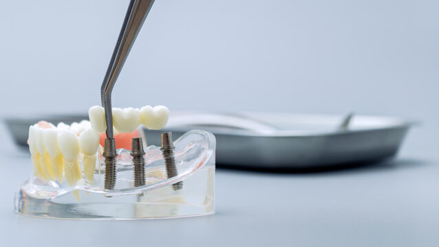Dental implantology concept: Artificial teeth bridge installation on a transparent jaw model with copy space.