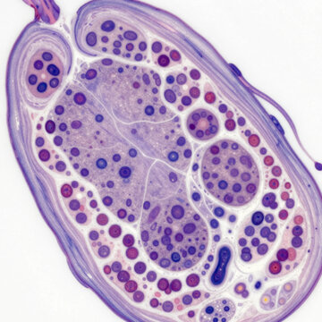 Histopathology of rheumatoid arthritis synovium