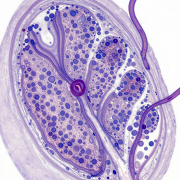 Histopathology of rheumatoid arthritis synovium